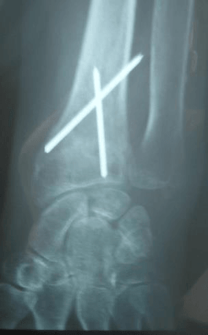 Radiographie du poignet montrant deux broches d’ostéosynthèse croisées dans le radius