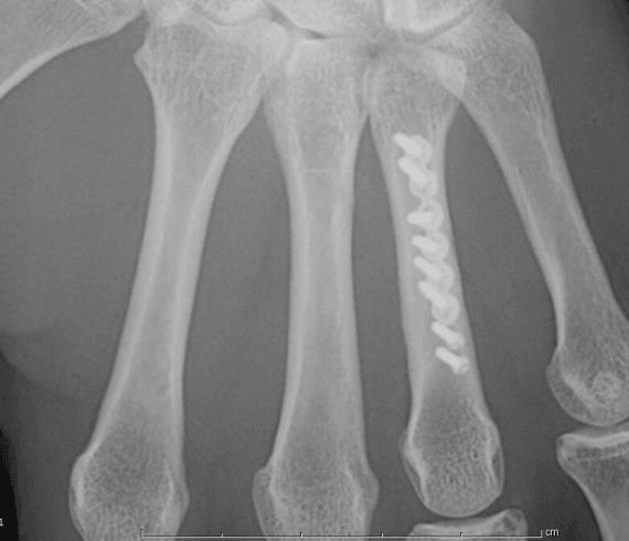 Radiographie de la main montrant une plaque vissée sur un métacarpien