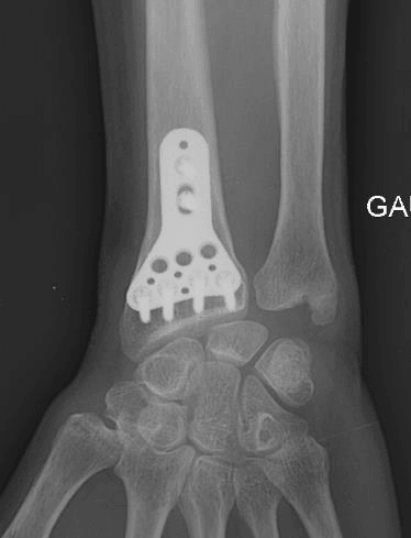 Radiographie du poignet de face montrant une plaque vissée sur le radius